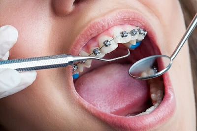 Các loại hình niềng răng người lớn 