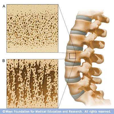 osteoporosis|OsTeoporoses|oStoeporosis|ostEoporoziz|ozteoporosis