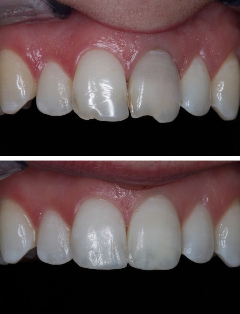 Trám răng – cách chữa răng thưa dứt điểm