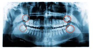 Impacted Wisdom Teeth- Causes, Signs and Symptoms