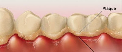 Cạo vôi răng bằng cách nào an toàn hiệu quả? 1
