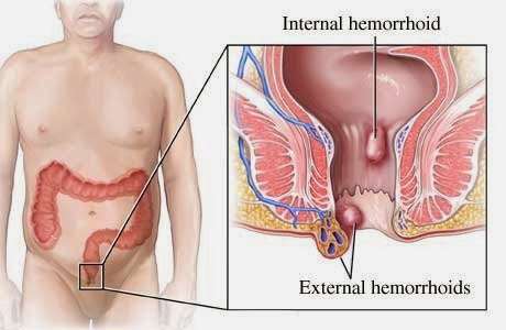 obat penyakit wasir, obat penyakit wasir ringan, obat penyakit wasir yang ampuh, obat penyakit wasir luar, obat penyakit wasir dalam, obat penyakit ambeien atau wasir, obat penyakit wasir internal, obat penyakit wasir yg ampuh, obatnya penyakit wasir, penyakit obat wasir ampuh, tanaman obat penyakit wasir, nama obat penyakit wasir, ramuan obat penyakit wasir, buah obat penyakit wasir, tumbuhan obat penyakit wasir, obat penyakit wasir ambeien, obat penyakit wasir secara alami, obat untuk penyakit wasir akut, obat untuk penyakit wasir/ ambeien, obat buat penyakit wasir