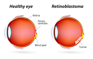 Retinoplastoma