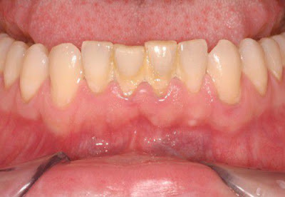 Vì sao răng bị ố vàng?
