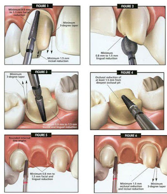 Điều trị răng hô, vẩu bằng cách bọc răng sứ