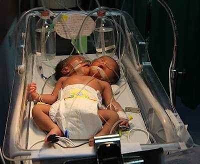 conjoined twins abby and brittany. Conjoined Twins Abby And
