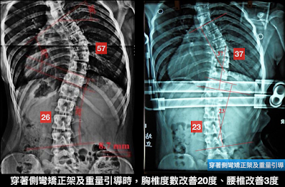 脊椎側彎矯正架, 脊椎側彎惡化, 脊椎側彎矯正, 脊椎側彎 物理治療, 脊椎側彎復健, 脊椎側彎治療