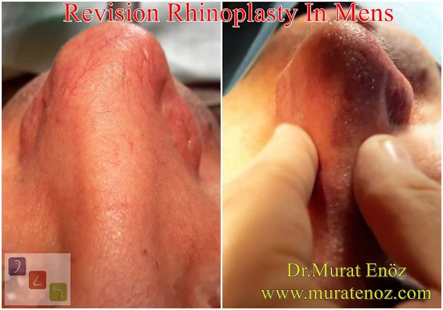 Revision Nose Job Surgery for Men - Revision Male Rhinoplasty - Men's Revision Rhinoplasty - Revision Nose Reshaping for Men - Mens Revision Rhinoplasty - Revision Nose Job Rhinoplasty for Men - Best Revision Rhinoplasty For Men Istanbul - Revision Nose Aesthetic for Men - Male Revision Nose Operation - Male Revision Rhinoplasty Surgery in Istanbul - Male Revision Rhinoplasty Surgery in Turkey - Male Revision Nose Aesthetic Surgery - Revision Rhinoplasty In Mens