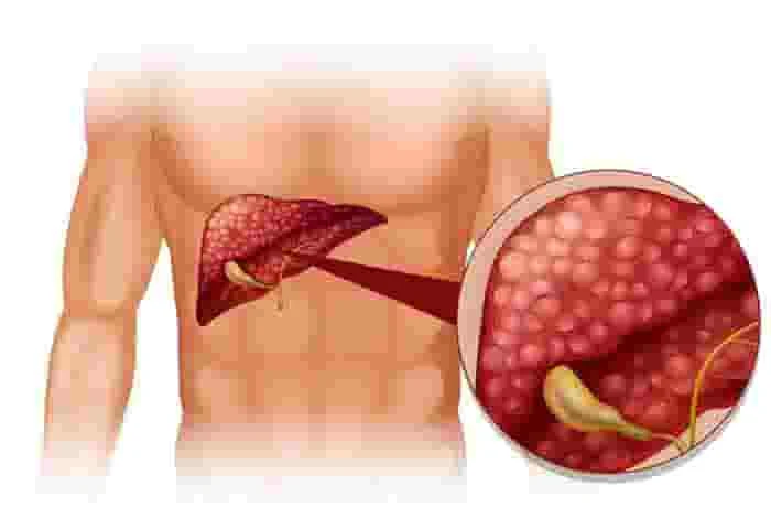 News, News-Malayalam-News, National, National-News, Health, Health-News, Indian Society of Gastroenterology reported an increase in liver inflammation patients in society.