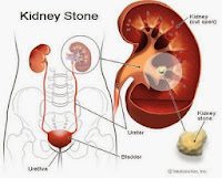 Ciri-ciri Penyakit Batu Ginjal dan Obat Herbalnya