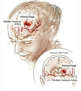 Pengobatan Alami Pendarahan di Otak Akibat Stroke