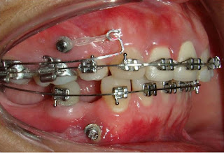 Quá trình niềng răng hô-1