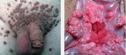 Gejala Infeksi Virus Hpv