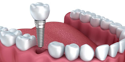 Trồng răng implant có tốt không? 1