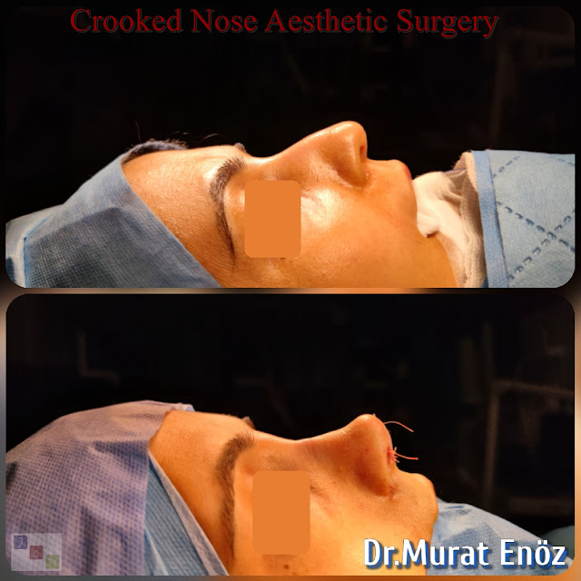 Rhinoplasty Operation For Crooked Nose,Crooked Nose Aesthetic Surgery For Female,Twisted Nose Rhinoplasty,