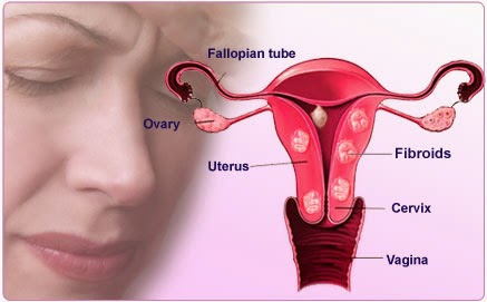 cara kecutkan fibroid