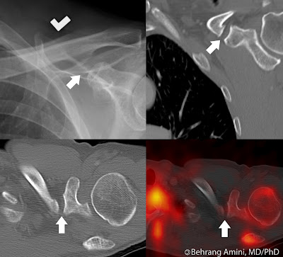 Distal Radioulnar Joint. distal radioulnar joint,