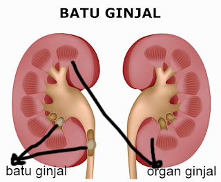 obat kencing batu ginjal, obat kencing batu atau batu ginjal, obat batu ginjal di saluran kencing, obat kencing batu/batu ginjal, obat kencing batu dan ginjal