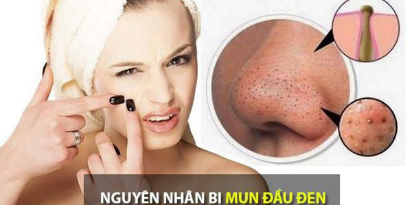 Khám phá những cách điều trị mụn đầu đen hiệu quả đơn giản ngay tại nhà