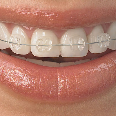 Các loại niềng răng cho răng lệch lạc