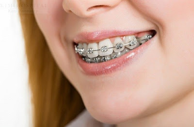 Điều trị hàm răng với phương pháp niềng răng
