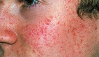 http://www.nhs.uk/Conditions/Acne/PublishingImages/M108444-Acne_342x198.jpg