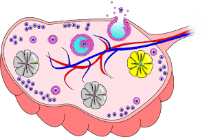 Ovarian Cancer