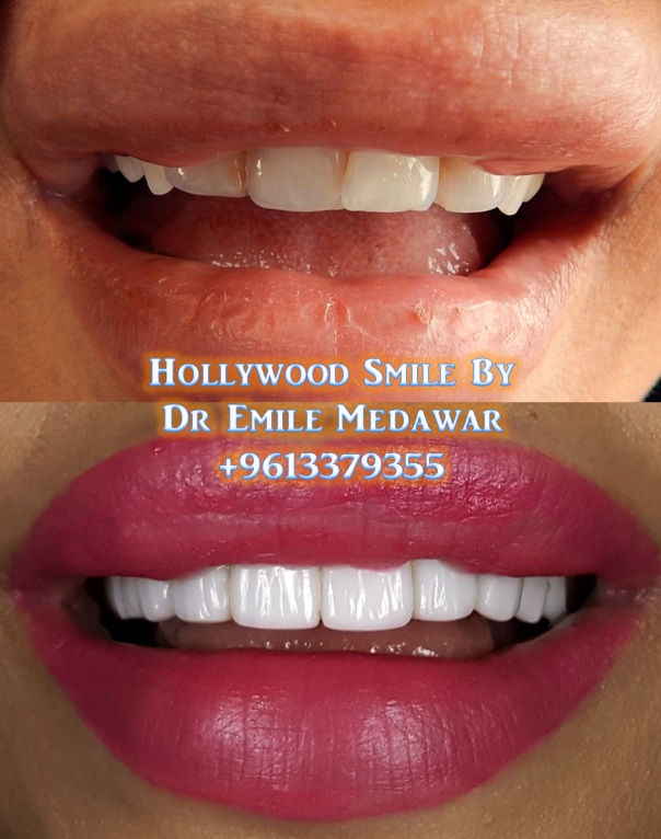 Hollywood Smile Clinic,Dr Emile Medawar, 00 961 3 379355 ...