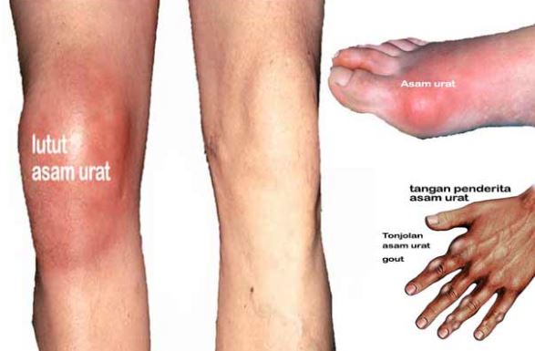 Kolesterol,pengertian,akibat kolesterol tinggi,cara menurunkan kolesterol,kolesterol jahat,kolesterol baik,LDL,HDL,resiko kolesterol tinggi,bahaya kolesterol tinggi,gejala kolesterol,cara mengobati kolesterol,obat herbal kolesterol,penyakit jantung,makanan untuk kolesterol tinggi,ciri-ciri penyakit kolesterol tinggi,makanan penyebab kolesterol,obat tradisional kolesterol,obat herbal kolesterol,