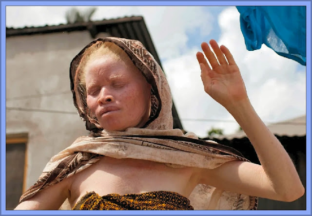 Albinos In Africa Face Numerous Threats