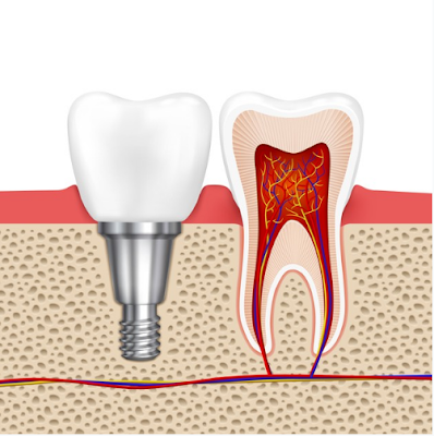 Root Canal Long Island