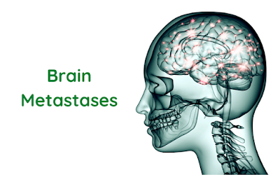 Brain Metastases