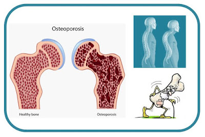 Gb. Kesehatan Tulang : Penyebab Tulang Keropos & Obat Osteoporosis