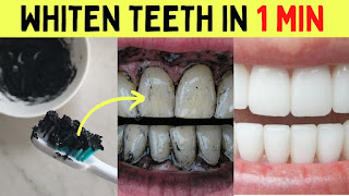 وصفة الفاخر والحامض لتبييض الأسنان