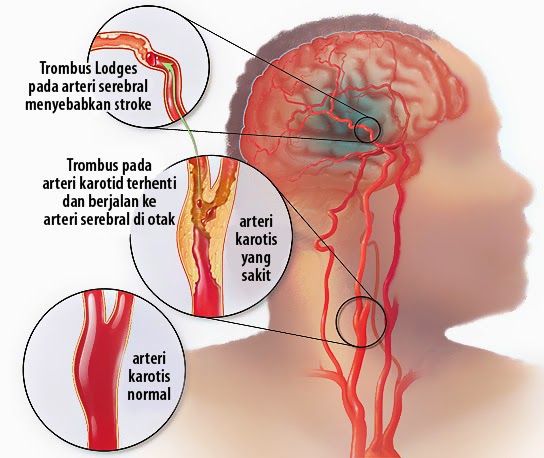 Penyakit Stroke, stroke