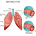 TOP 10 Home Remedies for Bronchitis