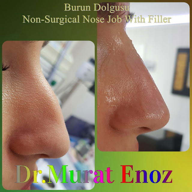 Non-surgical rhinoplasty in Istanbul - The 5 Minute Nose Job in Istanbul - Non-surgical nose job - Nose filler injection Turkey - Injectable nose job - Liquid rhinoplasty