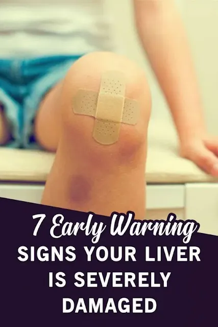 7 Early Signs Your Liver Is Severely Damaged