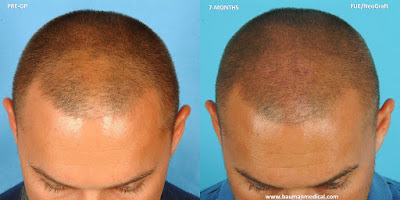 What is FUE hair transplant