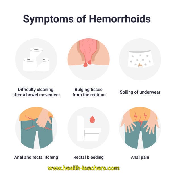 What is hemorrhoids? Chronic hemorrhoids - signs and symptoms of hemorrhoids - Health-Teachers