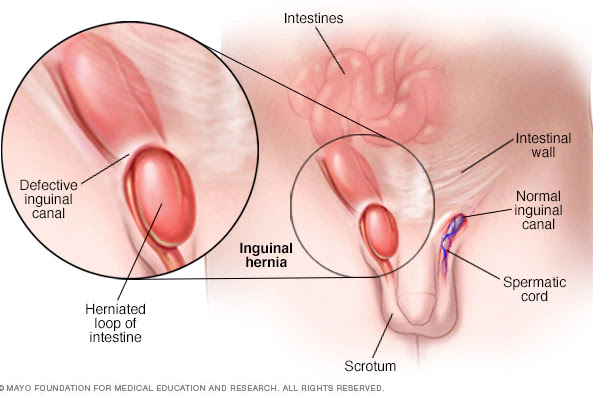 HERNIA