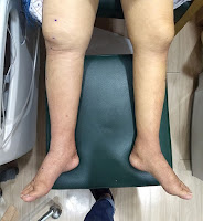 Edema - swollen legs due to fluid retention