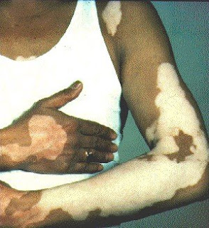 vitiligo treatment