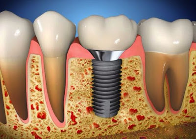 trong-rang-implant-co-dau-khong