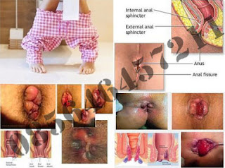 Cara Terbaik Mengatasi Wasir (Hemoroid) di Rumah