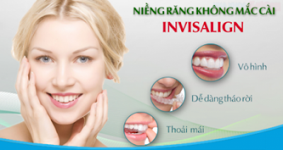 Ưu điểm của khí cụ Invisalign trong niềng răng