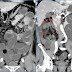 التصوير المقطعي (CT) - البطن والحوض