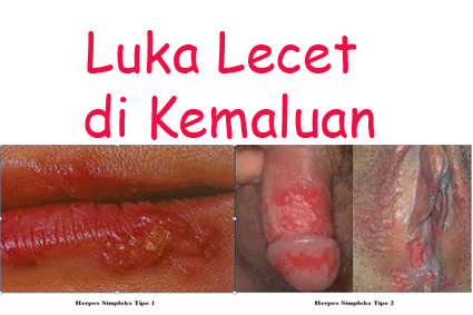 luka Lecet Pada KEMALUAN PRIA