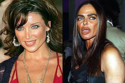 Celebrities Who Have Ruined Their Faces Due to Plastic Surgery