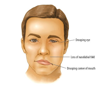 Obat Tradisional Bell's Palsy